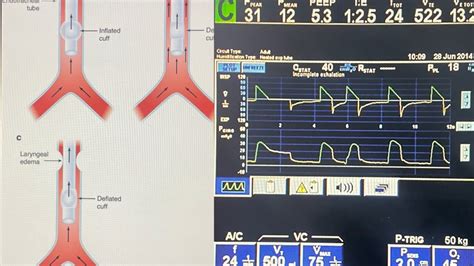 cuff leak test|Performance of the cuff leak test in adults in predicting。